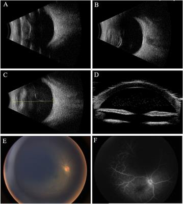 Case report: Unilateral panuveitis as a manifestation of Alport syndrome in a Chinese pediatric patient